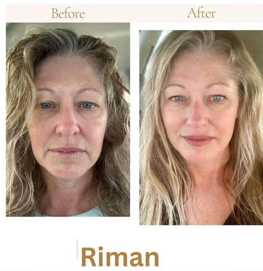 Resolving Skin Problems through Proper Hydration and Collagen Boost